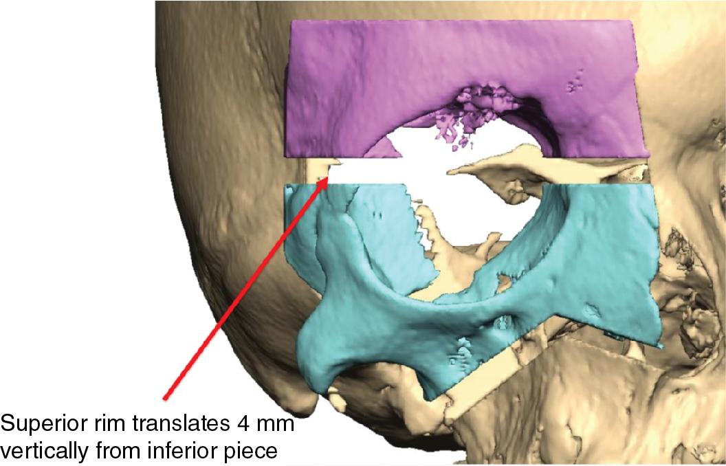 Fig. 10.2, Segmentation and vertical expansion of the orbit to improve orbital symmetry in a case of severe craniofacial microsomia.