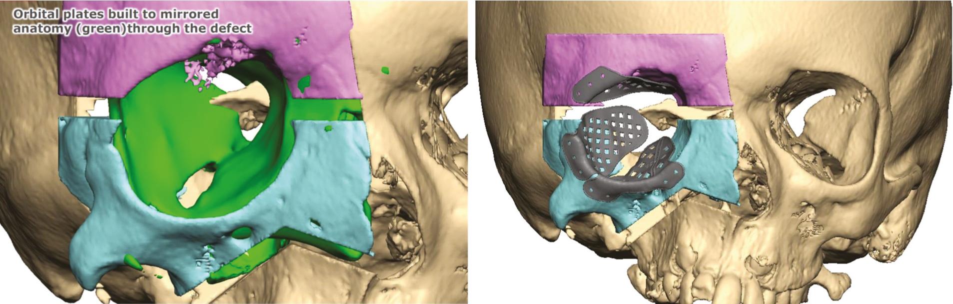 Fig. 10.3, Mirroring of the contralateral orbit is used to design internal orbital implants to address orbital volume asymmetry in an orbital box osteotomy case.