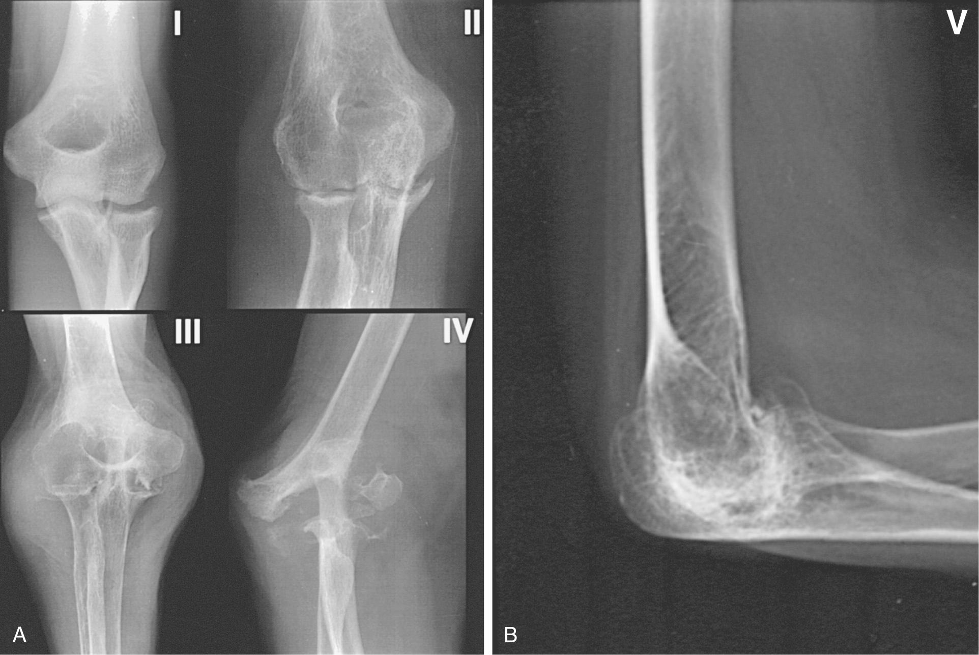 FIG 110.2, (A) Mayo radiographic classification of rheumatoid involvement of the elbow considers synovitis, articular involvement, and joint distraction (see text). (B) A type V radiographic presentation is one of ankylosis, as reported by Connor and associates. 7