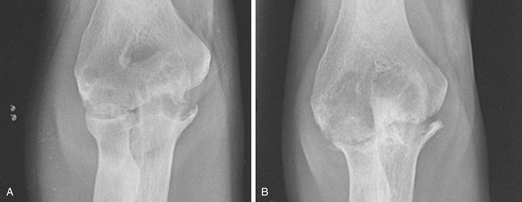 FIG 110.3, (A) Type IIIA involvement. (B) Three years after arthroscopic synovectomy, the patient has less pain and has maintained a 100-degree arc of motion.