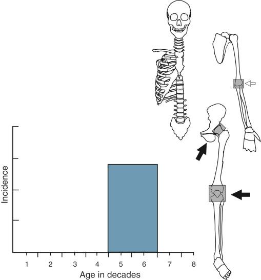 FIGURE 20-1, Synovial chondromatosis.