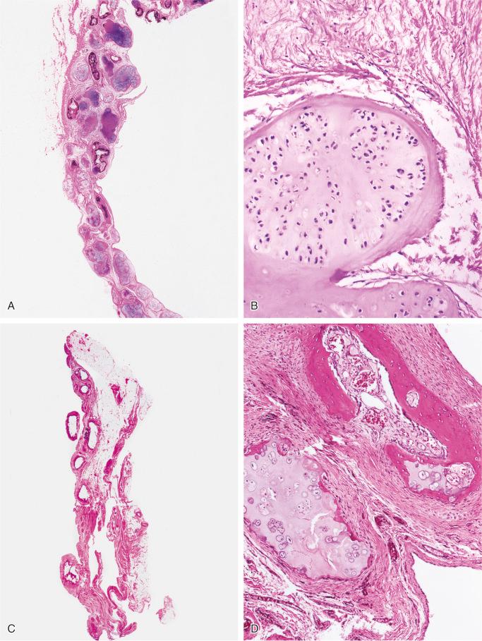 FIGURE 20-12, Synovial chondromatosis: microscopic features.