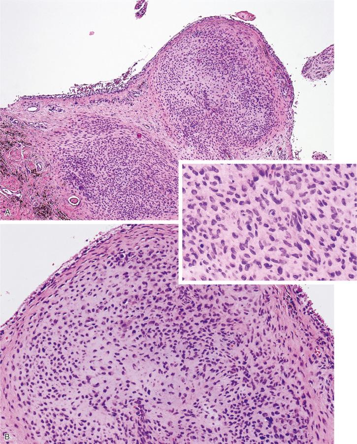 FIGURE 20-13, Synovial chondromatosis: microscopic features.