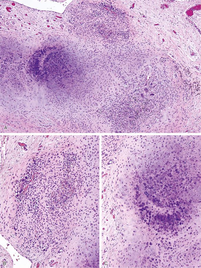 FIGURE 20-14, Synovial chondromatosis: microscopic features.