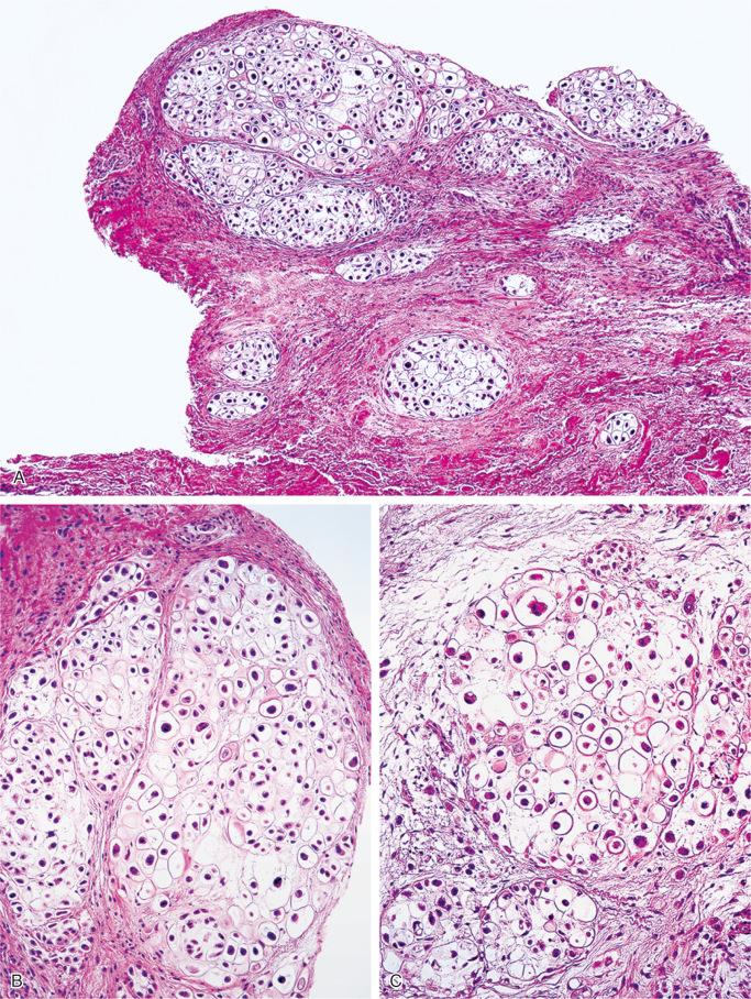 FIGURE 20-15, Synovial chondromatosis: microscopic features.