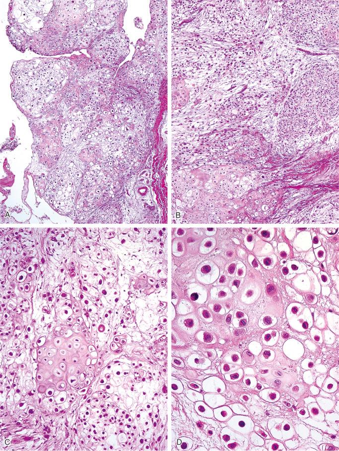 FIGURE 20-17, Synovial chondromatosis: microscopic features.