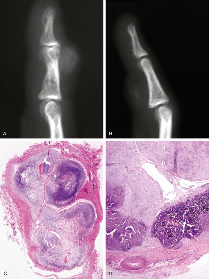 FIGURE 20-22, Tenosynovial chondrometaplasia (localized nodular form): radiographic and microscopic features.