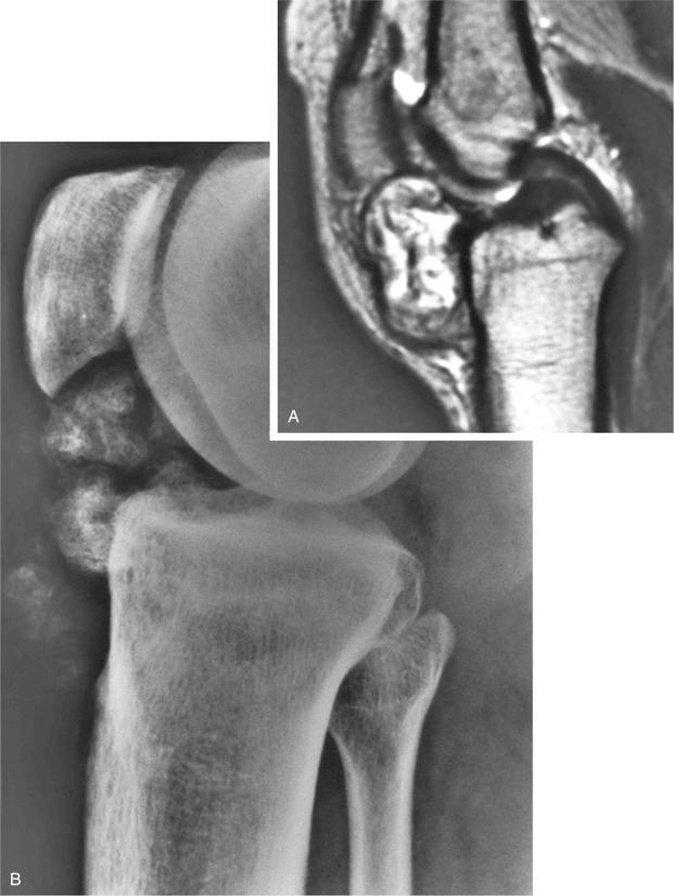 FIGURE 20-4, Synovial osteochondromatosis: radiographic features.