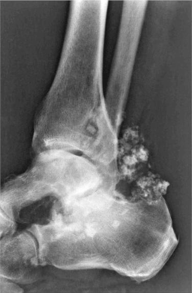 FIGURE 20-5, Synovial chondromatosis of ankle joint: radiographic features.