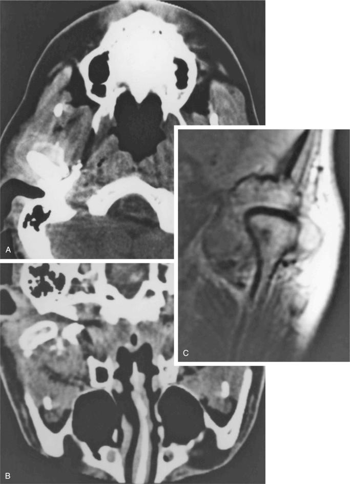 FIGURE 20-7, Synovial chondromatosis: radiographic features.