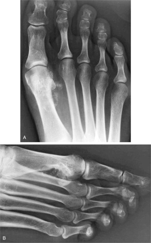 FIGURE 20-9, Synovial chondromatosis of tendon sheath: radiographic features.