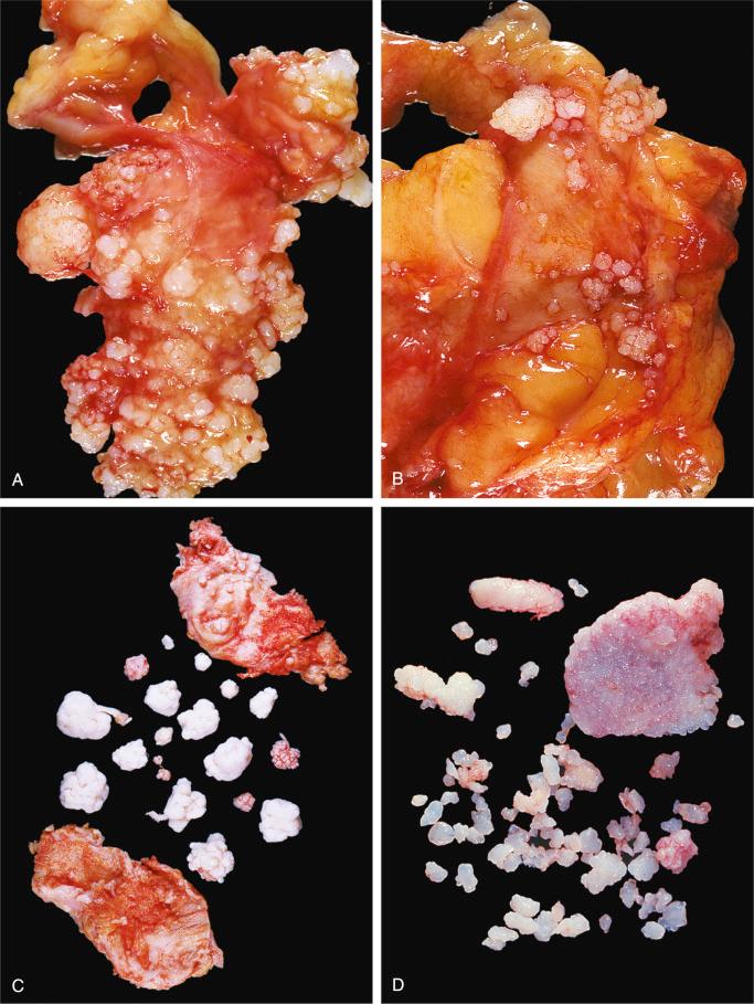 FIGURE 20-10, Synovial chondromatosis (diffuse form in major joints): gross features.