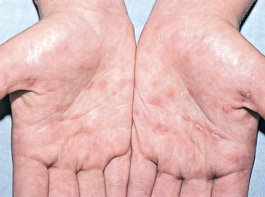 Fig. 245.2, Secondary syphilis. Ham-colored palmar macules on an adolescent with secondary syphilis.