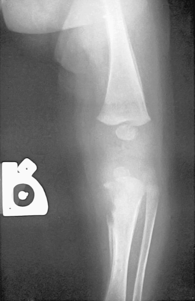 Fig. 245.3, Osteochondritis and periostitis in a newborn with congenital syphilis.