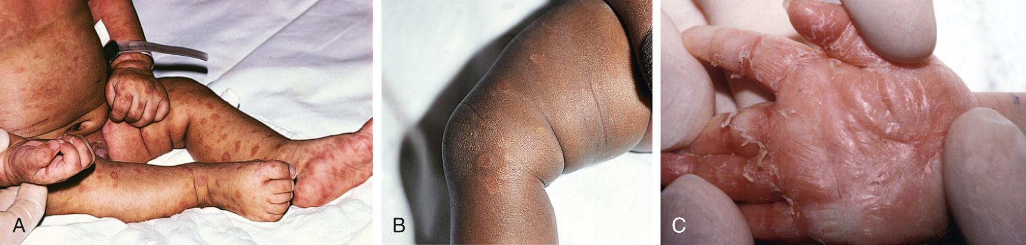 Fig. 245.4, A and B, Papulosquamous plaques in 2 infants with syphilis. C, Desquamation on the palm of a newborn's hand.