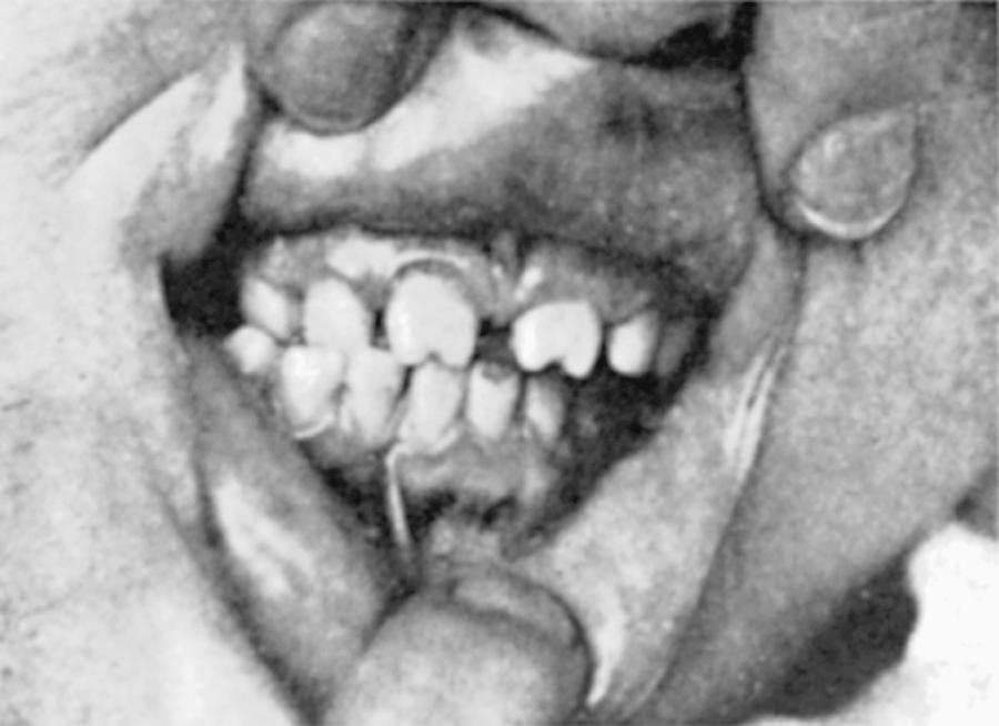 Fig. 245.6, Hutchinson teeth as a late manifestation of congenital syphilis.