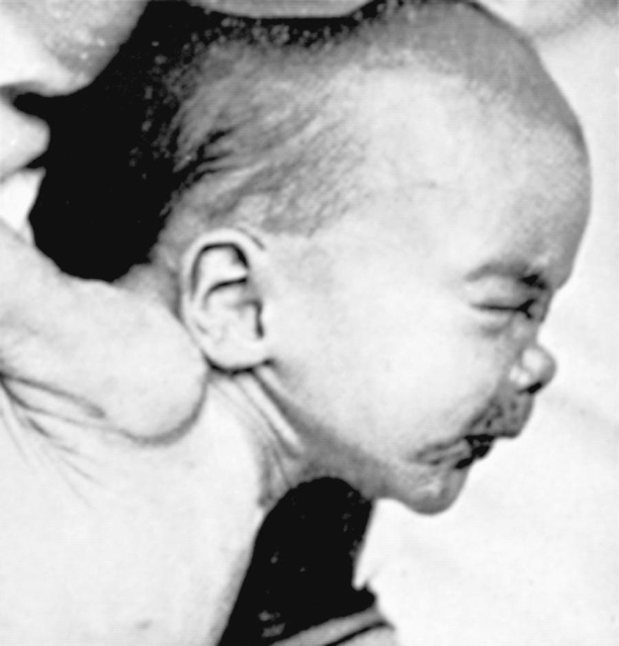 Fig. 245.7, Saddle nose in a newborn with congenital syphilis.