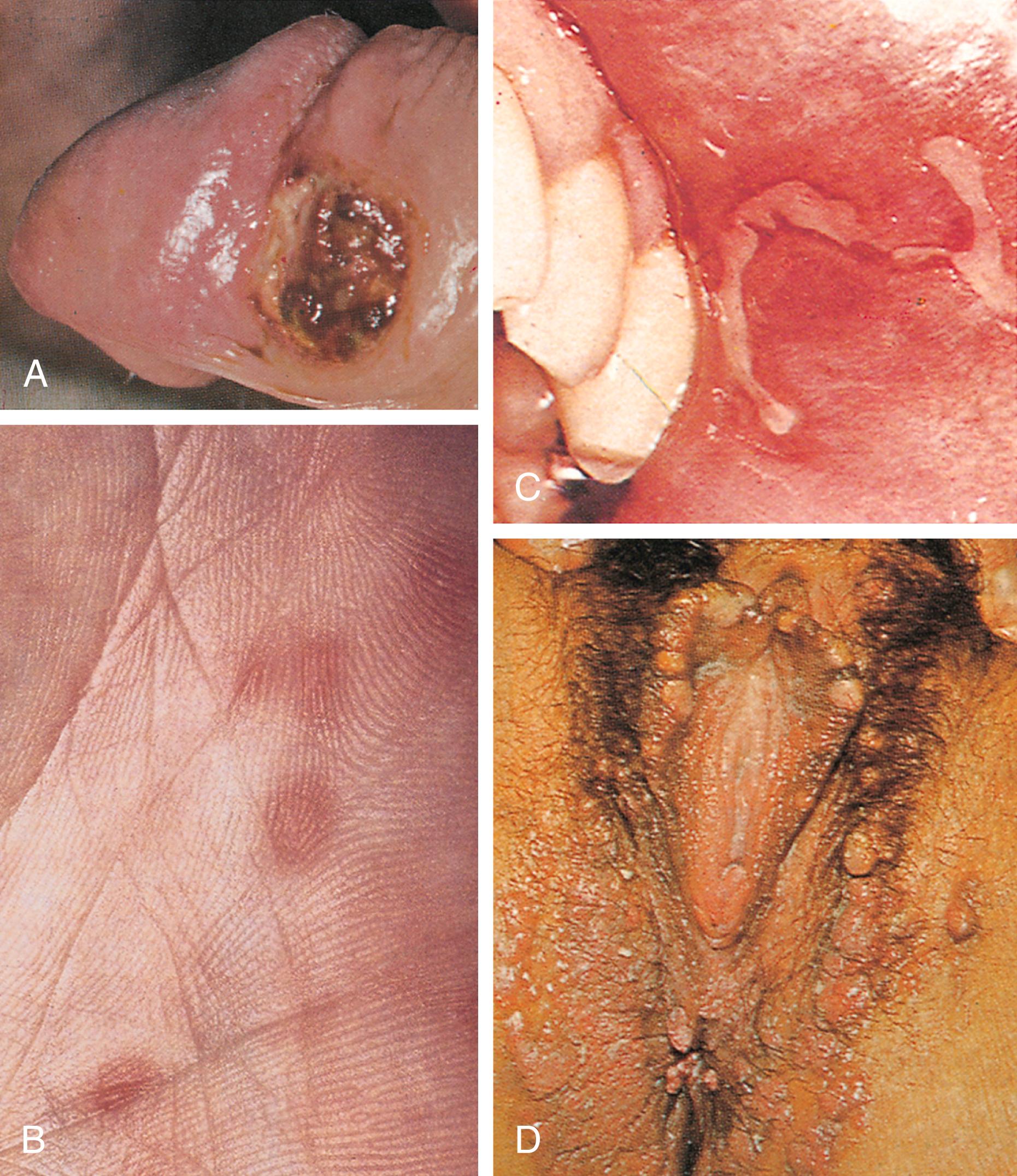 FIGURE 295-1, Syphilis lesions.