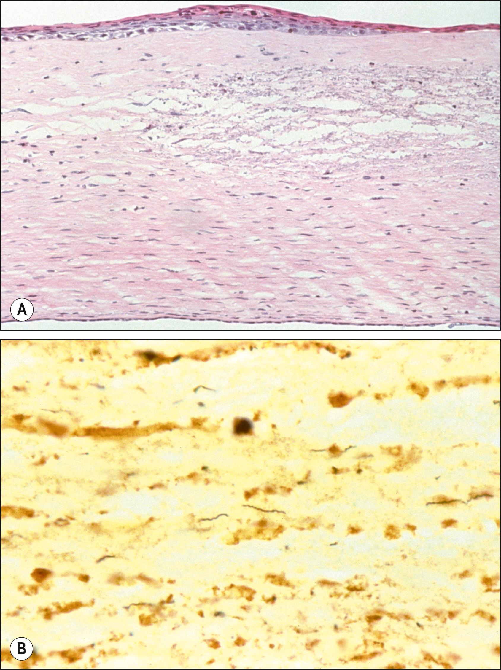 Fig. 84.2, Histopathologic sections during early congenital syphilis (PAS, ×40). ( A ) Necrosis of stroma. ( B ) Spirochetes between stromal lamellae (Warthin Starry, ×400).