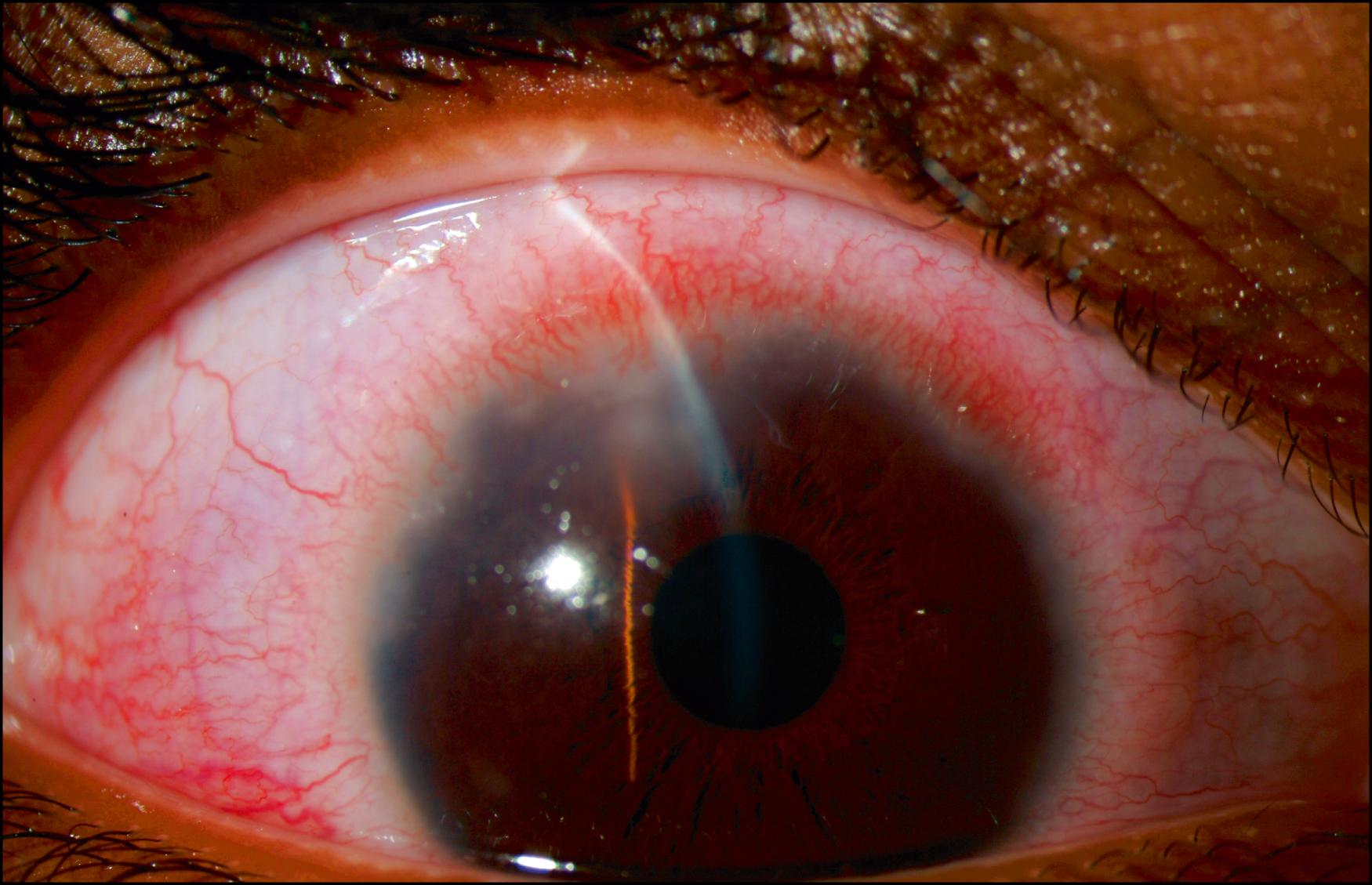 Fig. 84.3, Acute stromal keratitis with active corneal neovascularization. A 13-year-old boy was treated during infancy for congenital syphilis but developed bilateral hearing loss at 12 years of age. One month later, multifocal stromal keratitis with peripheral neovascularization affected the left eye. Six months later, as shown, peripheral stromal keratitis affected his contralateral right eye.