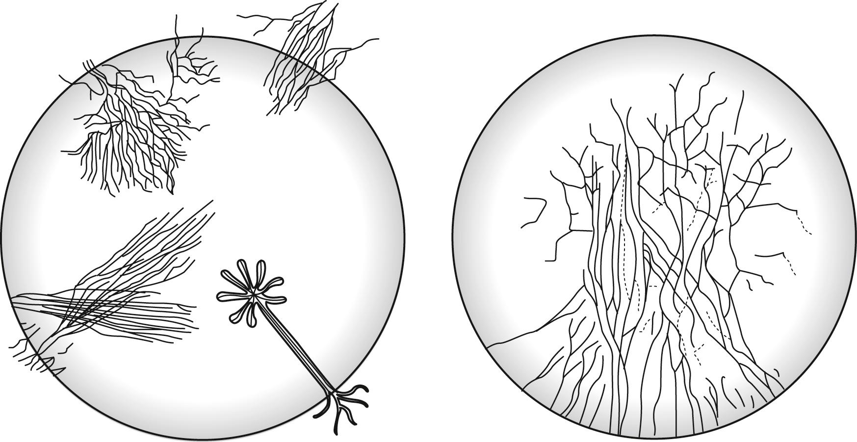 Fig. 84.4, Corneal neovascularization associated with syphilitic stromal keratitis. The left drawing shows various patterns of superficial stromal vessels. The right sketch depicts radiating vessels of the deep stroma.