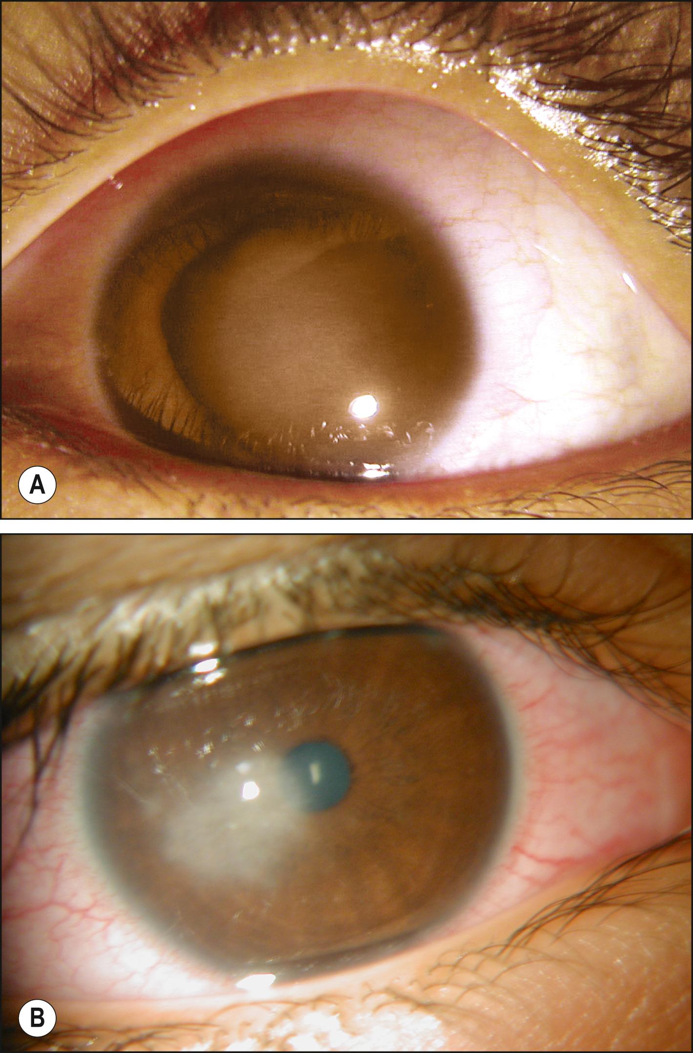 Fig. 84.5, Bilateral and recurrent syphilitic keratitis. ( A ) An 8-year-old boy developed stromal keratouveitis of his left eye during late congenital syphilis (reactive Treponema pallidum particle agglutination, 1:1024 rapid plasma reagin test, nonreactive cerebrospinal fluid venereal disease research laboratory test, and negative herpes simplex virus antibodies). Treatment included topical prednisolone and a course of intravenous penicillin G. ( B ) Stromal keratoiritis occurred 3 months later of his contralateral right eye. Stromal keratitis recurred in the left eye several months later.