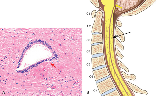 Figure 30.1, Anatomy of the central canal. (A) Hematoxylin and eosin staining of the normal central canal in the axial plane demonstrates the oval shape of the canal, which is lined by a single layer of columnar ependymal cells (red arrow) . (B) Sagittal image of the central canal demonstrates its macroscopic communication with the subarachnoid space at the obex (yellow arrow) , with theoretical microscopic channels positioned along the length of the cord also providing communication with the subarachnoid space (black arrow) .