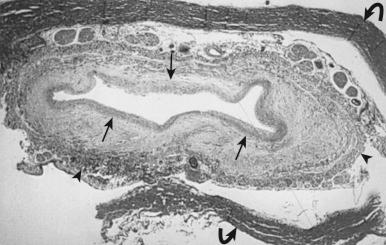 FIG. 94.1, Posttraumatic cord cyst. A low-power (×1.25) microscopic section image of a posttraumatic syringomyelia. There is a large, centrally located syrinx in the parenchyma of the spinal cord, which is surrounded by a thick wall of reactive astrocytes ( arrows ). The pia is thickened, and there are tissue changes that involve the spinal roots ( arrowheads ). The dura is also thickened ( curved arrow ).