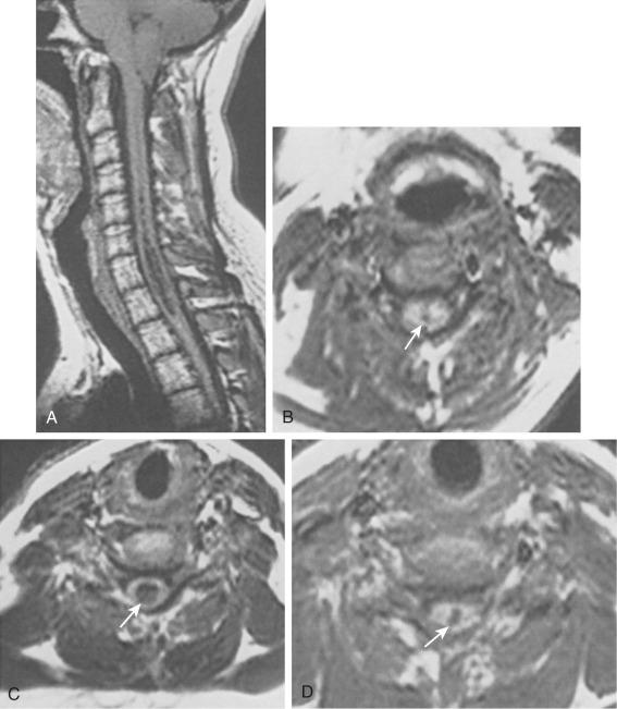 FIG. 94.2, Communicating syringomyelia (syringohydromyelia) with associated Chiari I malformation. (A) T1-weighted sagittal image shows ectopia of the cerebellar tonsils and an intramedullary cystic cavity extending from C2 to T2. (B–D) T1-weighted axial images demonstrate the central location of the cyst ( arrow ) at C5–C7.