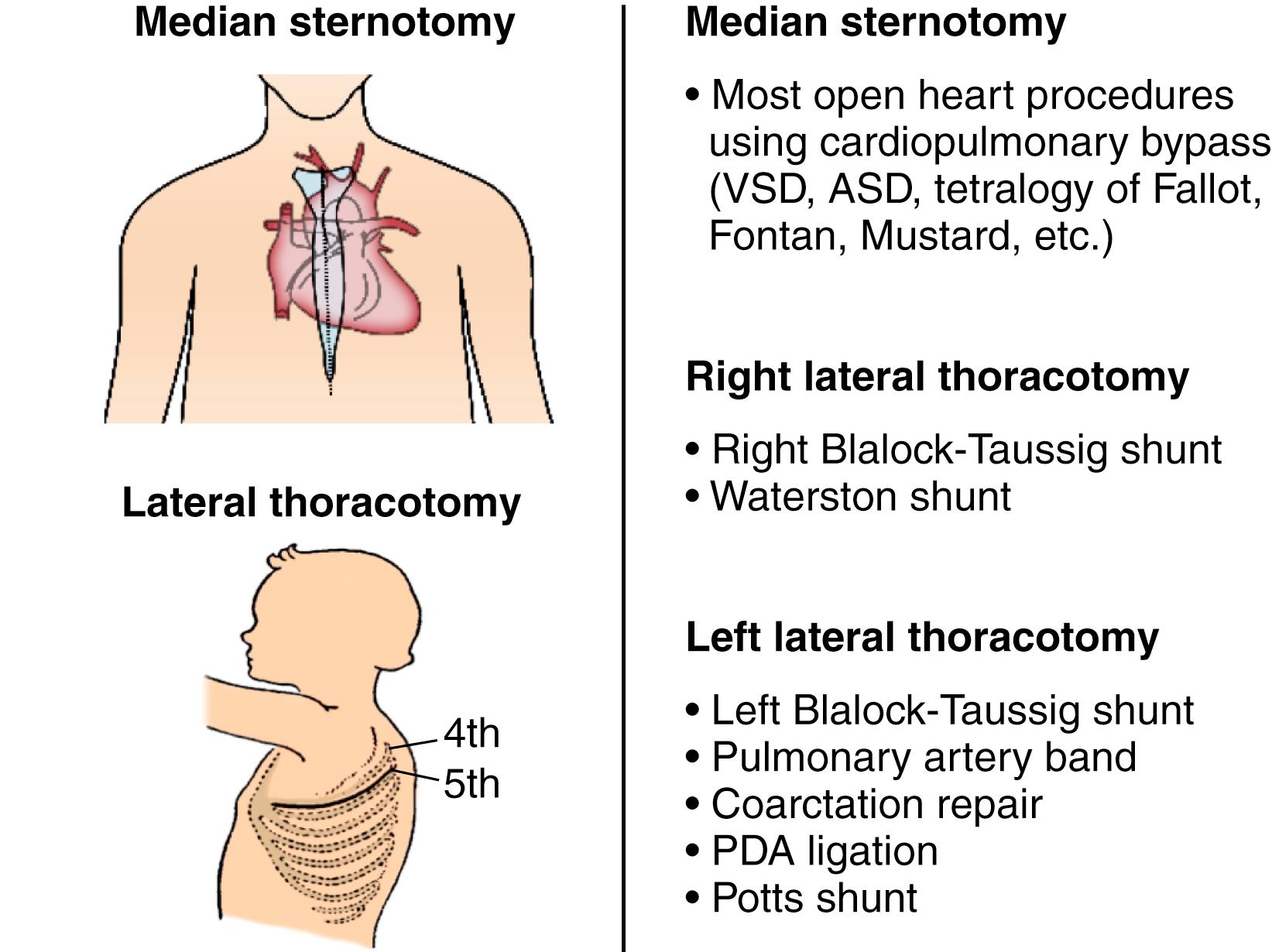 Figure 140.1, Schematic representation of the chest incisions and the likely congenital heart operations that may be performed through this approach. This information can be very helpful when the patient is unaware of the procedure or procedures that were performed. ASD, Atrial septal defect; PDA, patent ductus arteriosus; VSD, ventricular septal defect.