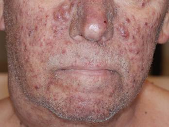 Fig. 37.1, Papulopustular rash to epidermal growth factor receptor inhibitors. A 58-year-old man with head and neck squamous cell carcinoma treated with cetuximab, paclitaxel, and carboplatin. The patient developed a papulopustular rash on his face and trunk 2 weeks after beginning therapy with cetuximab.