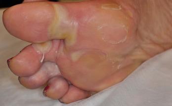 Fig. 37.2, Hand–foot skin reaction to multikinase inhibitors. A 72-year-old woman with thyroid cancer treated with sorafenib and everolimus. Within the first 2 weeks of starting therapy with sorafenib, the patient developed tender lesions with blisters on areas of increased pressure on her feet.