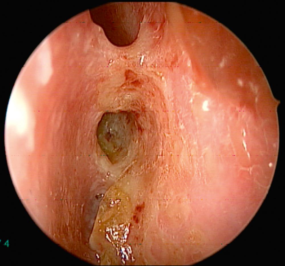 Fig. 51.1, Endoscopic view of right nasal cavity demonstrates crusting, hyperemia, ulceration, and scarring in a patient having active granulomatosis with polyangiitis.