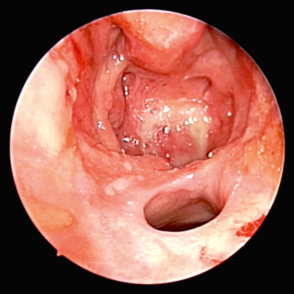 Fig. 51.2, Endoscopic view demonstrates complete septal perforation, erosion of paranasal structures, and palate perforation, resulting in the so-called common cavity configuration in granulomatosis with polyangiitis.