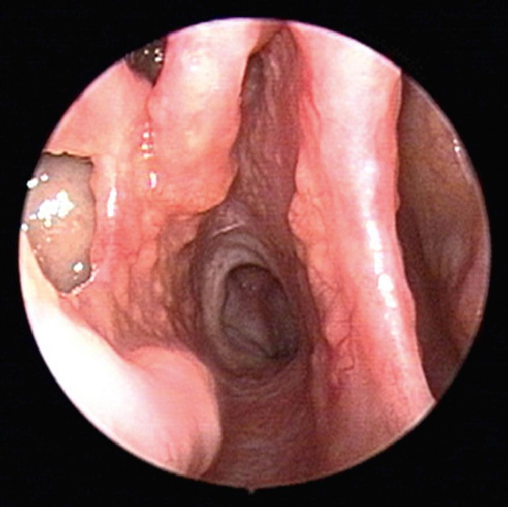 Fig. 51.3, Endoscopic view of the right nasal cavity in a patient with sarcoidosis demonstrates diffuse submucosal nodules along the septum and lateral nasal wall.