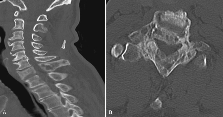 FIG 34-1, PDB. Sagittal and axial CT of the cervical spine demonstrates enlarged C7 vertebra with involvement of the anterior and posterior elements. There is associated loss of height of the vertebra due to bone softening. Note “picture frame” appearance of the spinous process.