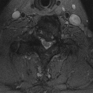 FIG 34-3, PDB (same patient as Fig. 34-1 ). Axial T2-weighted gradient echo image demonstrates severe bilateral neural foraminal stenosis and central canal encroachment secondary to pagetoid changes.