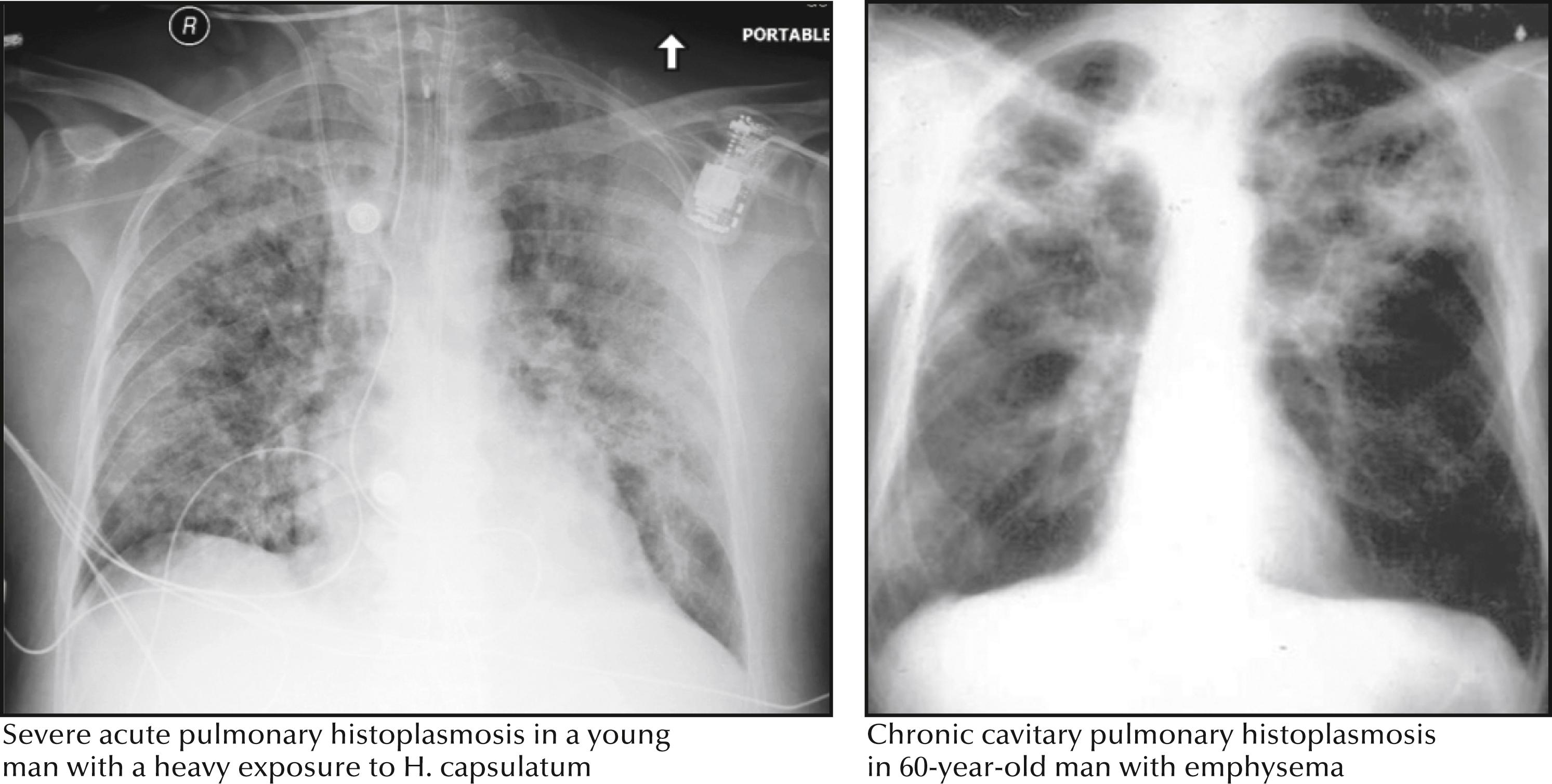 Fig. 40.2, Pulmonary histoplasmosis.