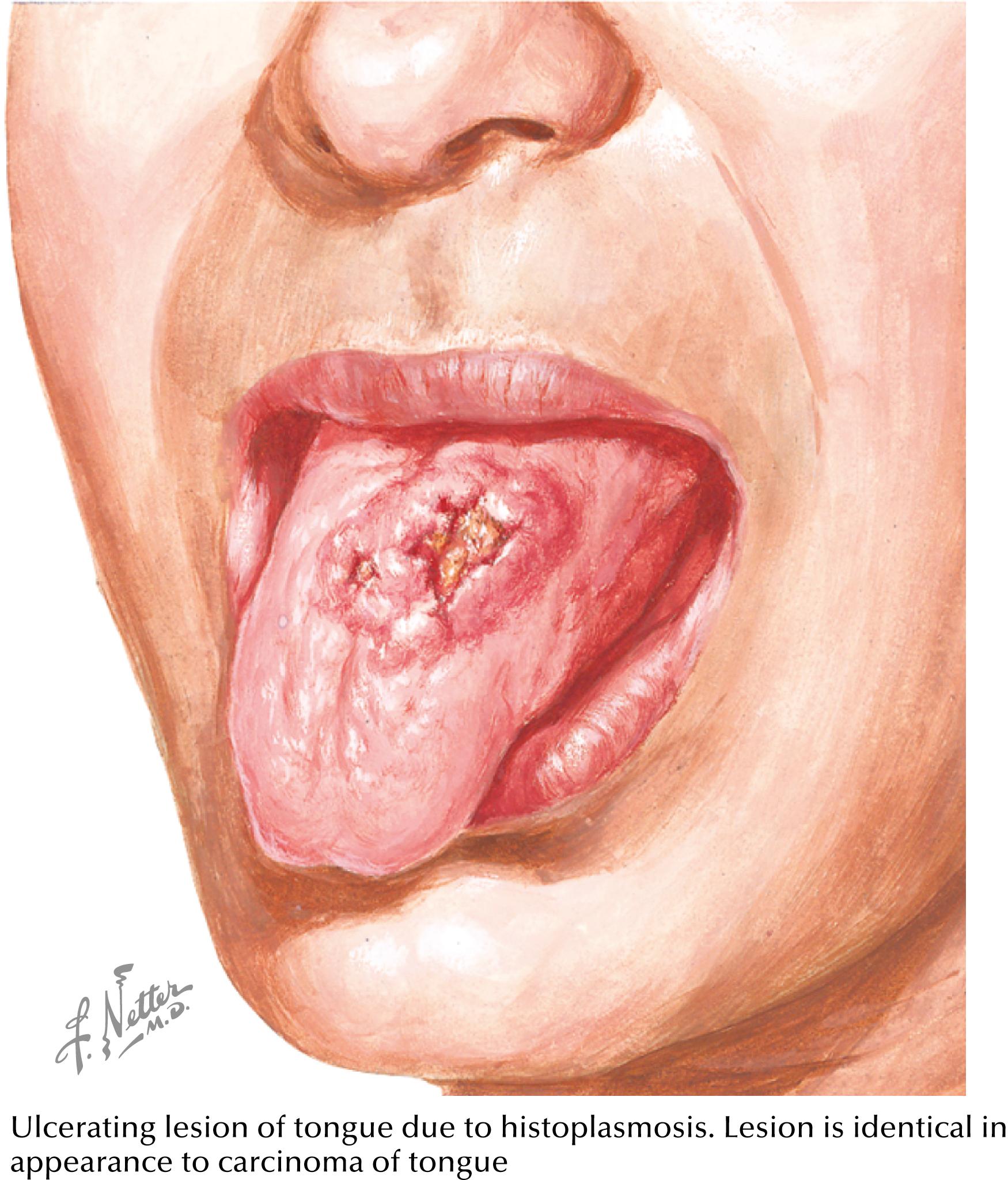 Fig. 40.3, Mucosal ulceration.