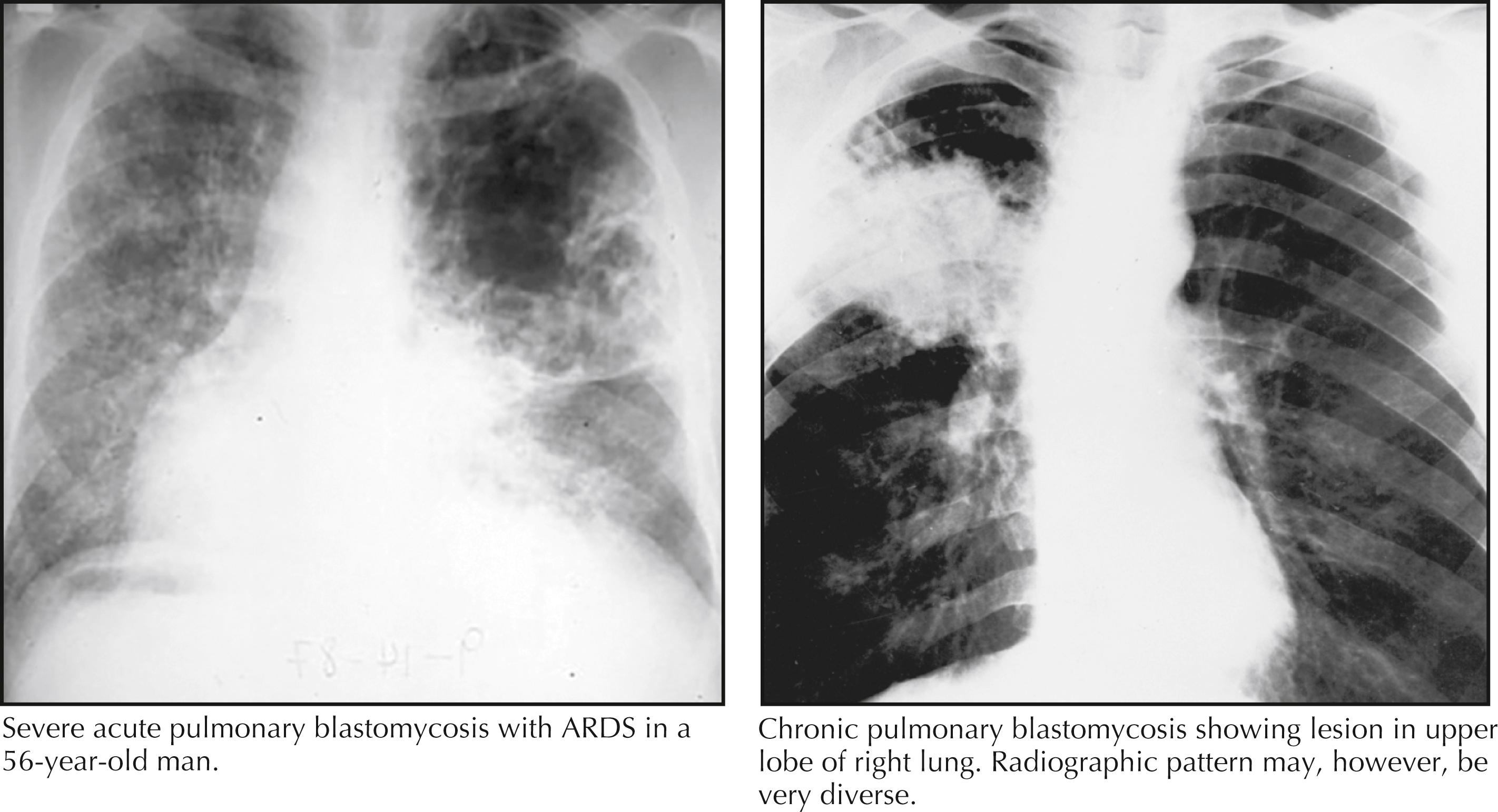 Fig. 40.4, Pulmonary blastomycosis. ARDS, Acute respiratory distress syndrome.