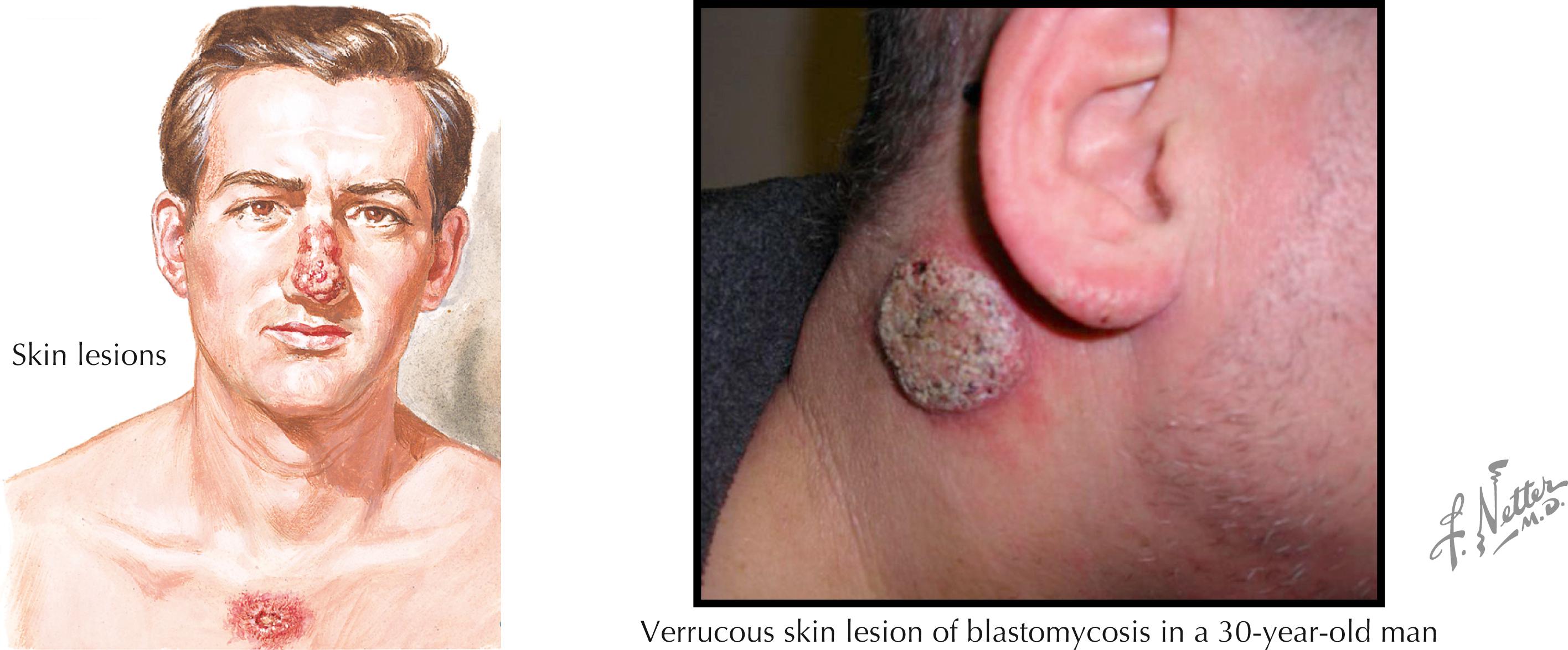 Fig. 40.5, Skin lesions in blastomycosis.