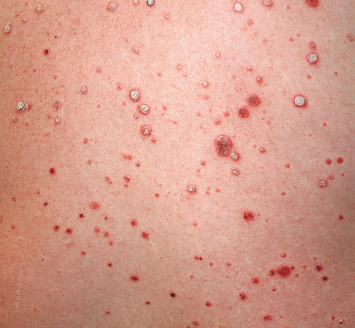 Fig. 128.2, Interferon-induced flare of psoriasis.