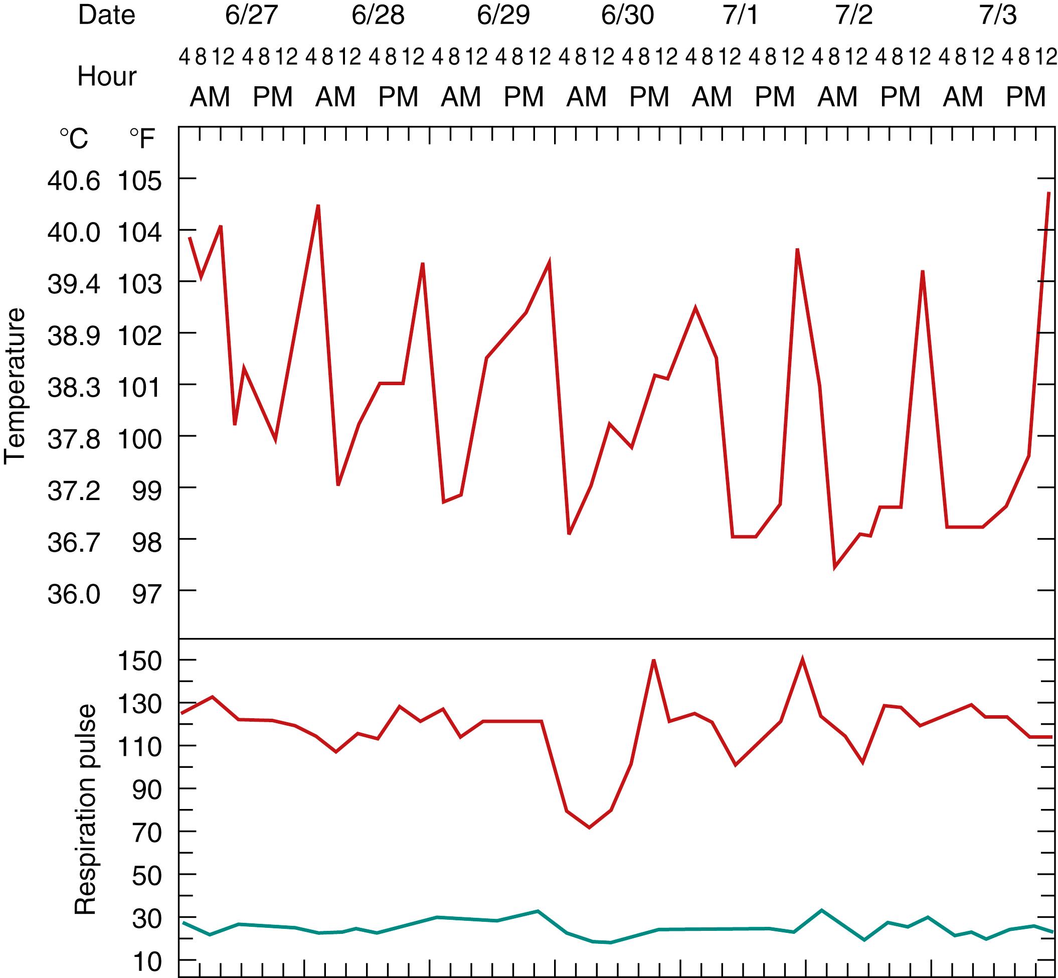 Fig. 17.1, Intermittent fever of systemic juvenile idiopathic arthritis (sJIA) in a 3-year-old girl. The fever spikes usually occurred daily in the late evening to early morning (quotidian pattern), returned to normal or below normal, and were accompanied by severe malaise, tachycardia, and rash.