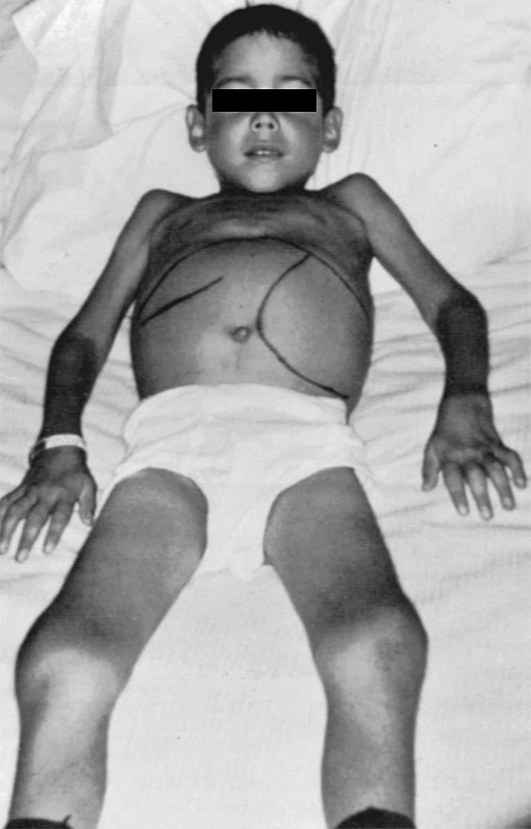 Fig. 17.3, An 8-year-old boy who had onset of systemic juvenile idiopathic arthritis (sJIA) at the age of 4 years. There is symmetrical large and small joint arthritis. Note the axillary lymphadenopathy and marked hepatosplenomegaly.