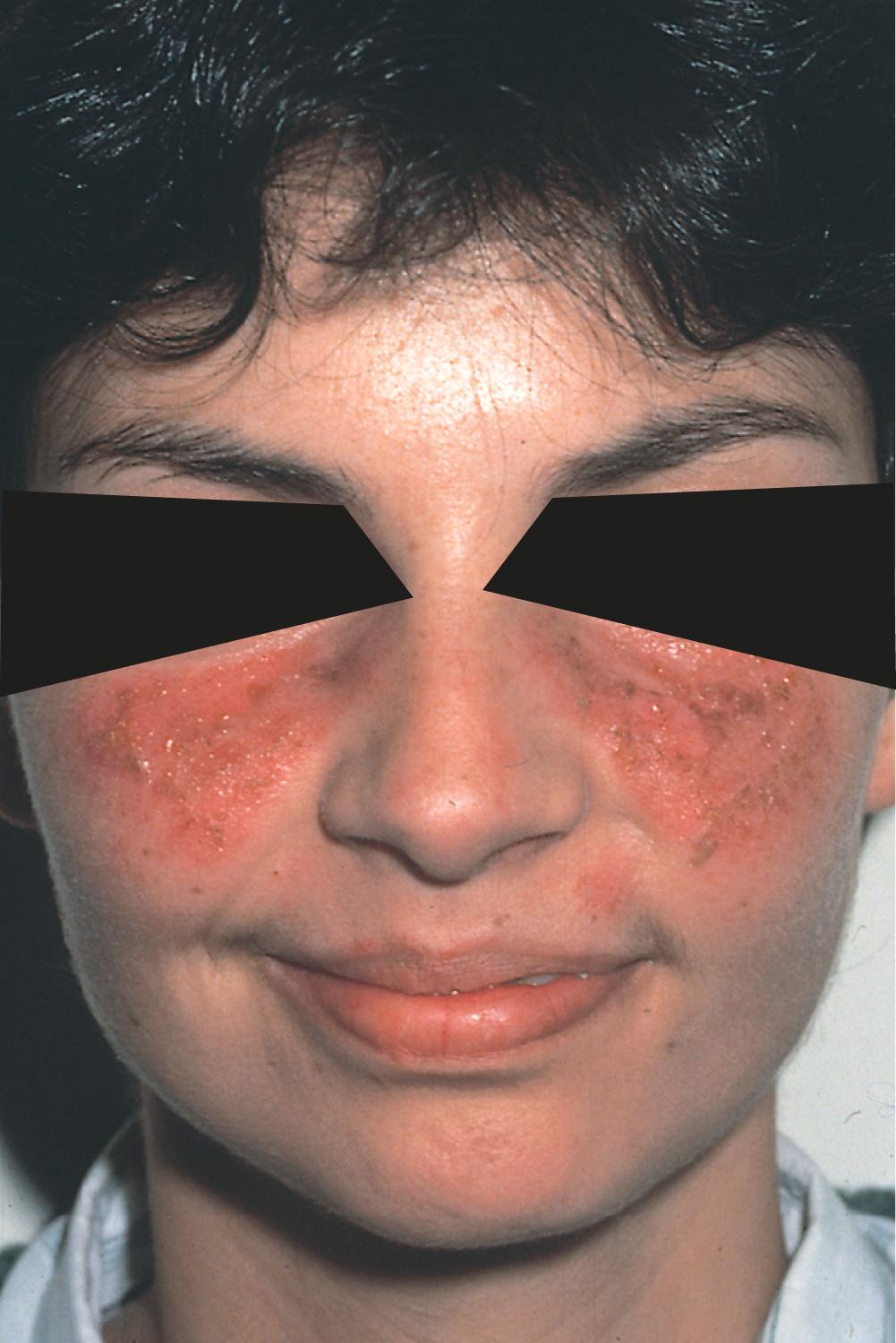 FIGURE 245-1, Malar rash in a patient with systemic lupus erythematosus.