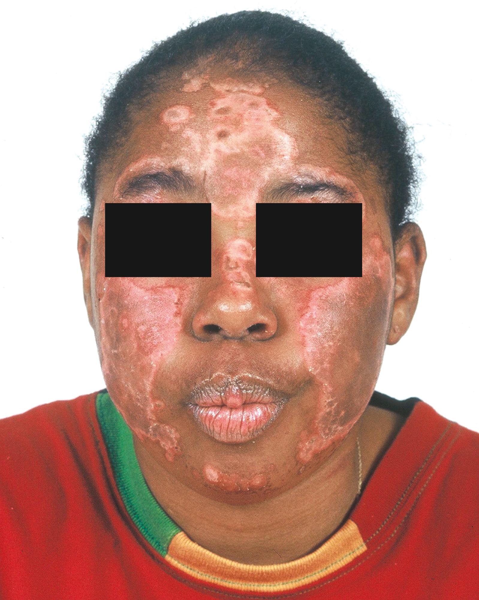 Fig. 23.11, Photosensitive rash