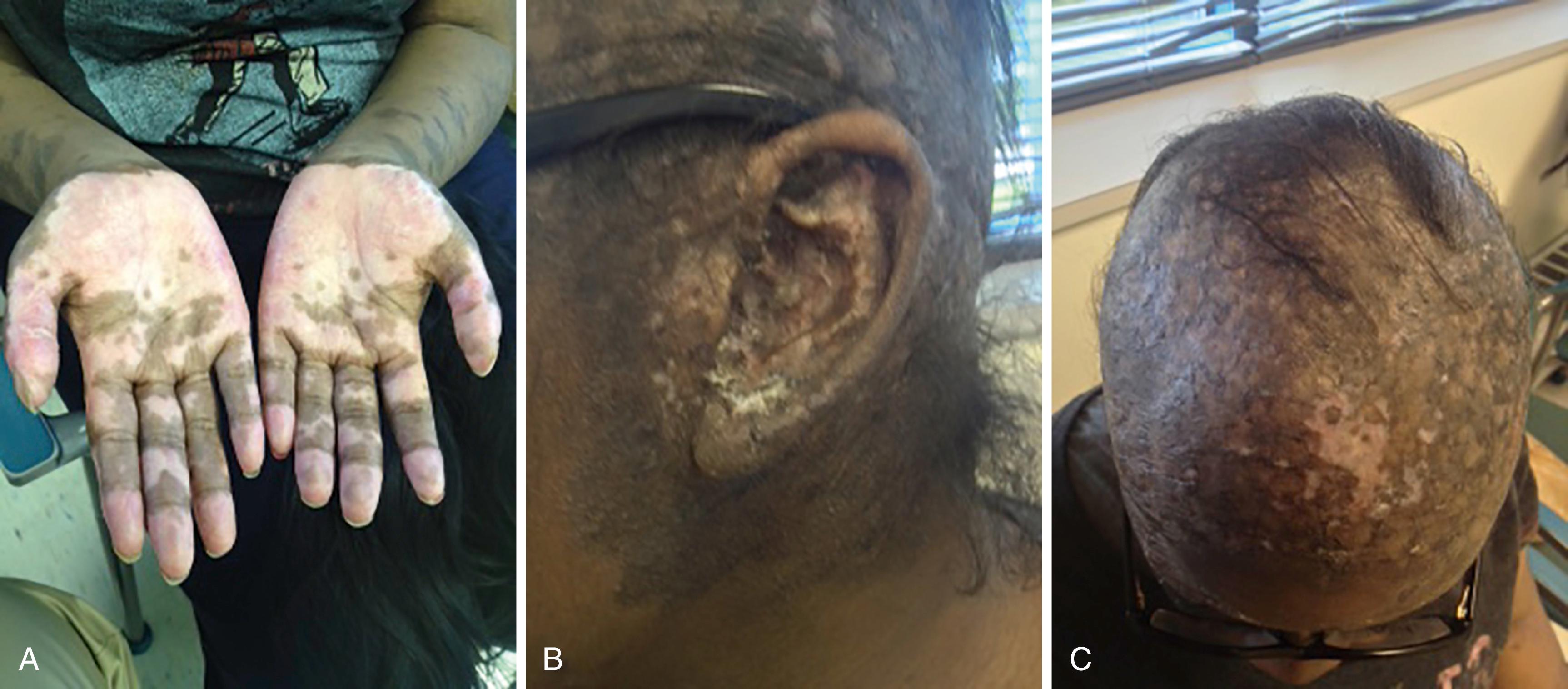 Fig. 23.12, Discoid rash. Diffuse discoid rash over the hands ( A ), ear ( B ), and scalp ( C ).