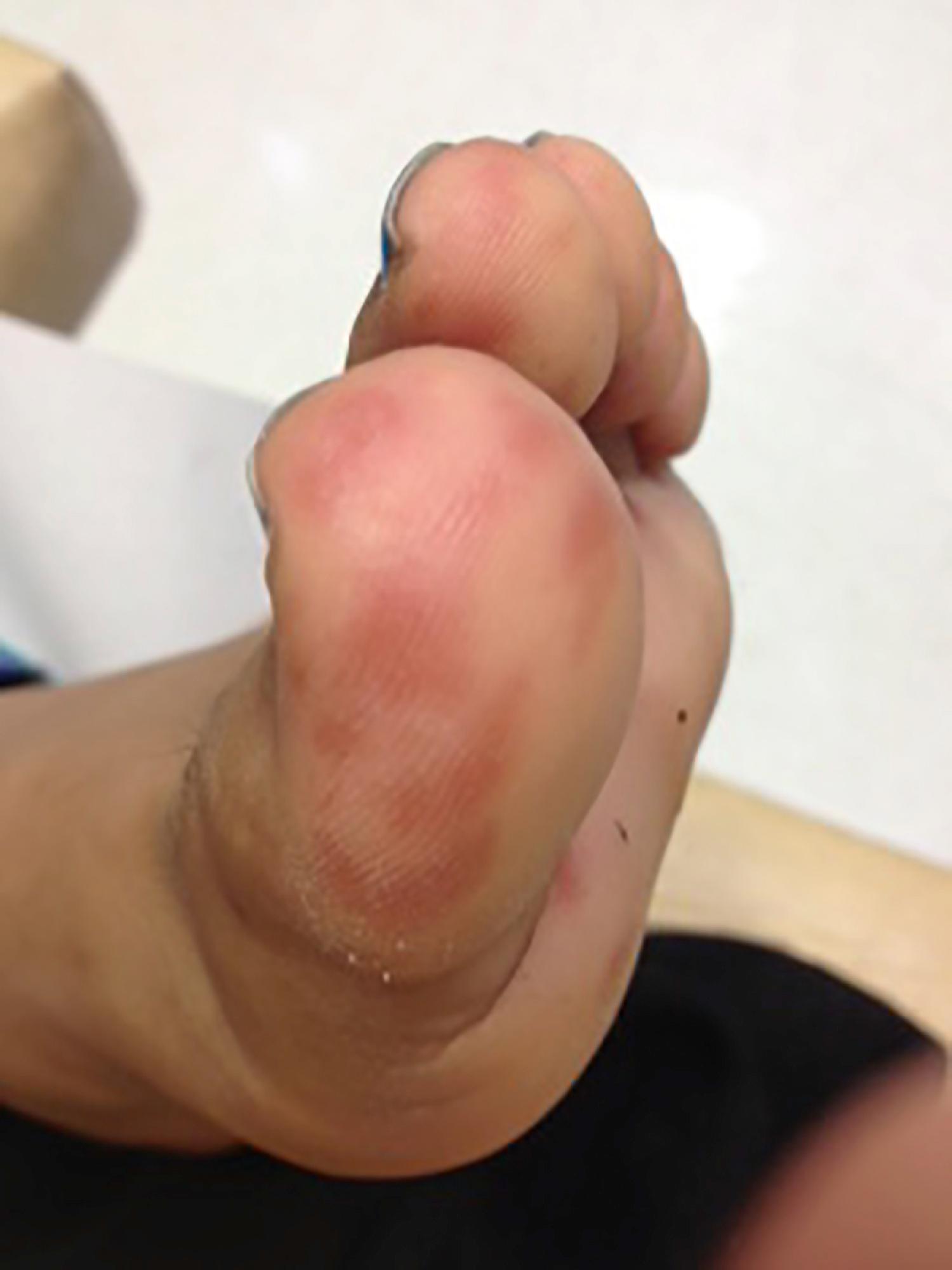 Fig. 23.14, Vasculitis seen as punctate erythema of the toes of a child with systemic lupus erythematosus.