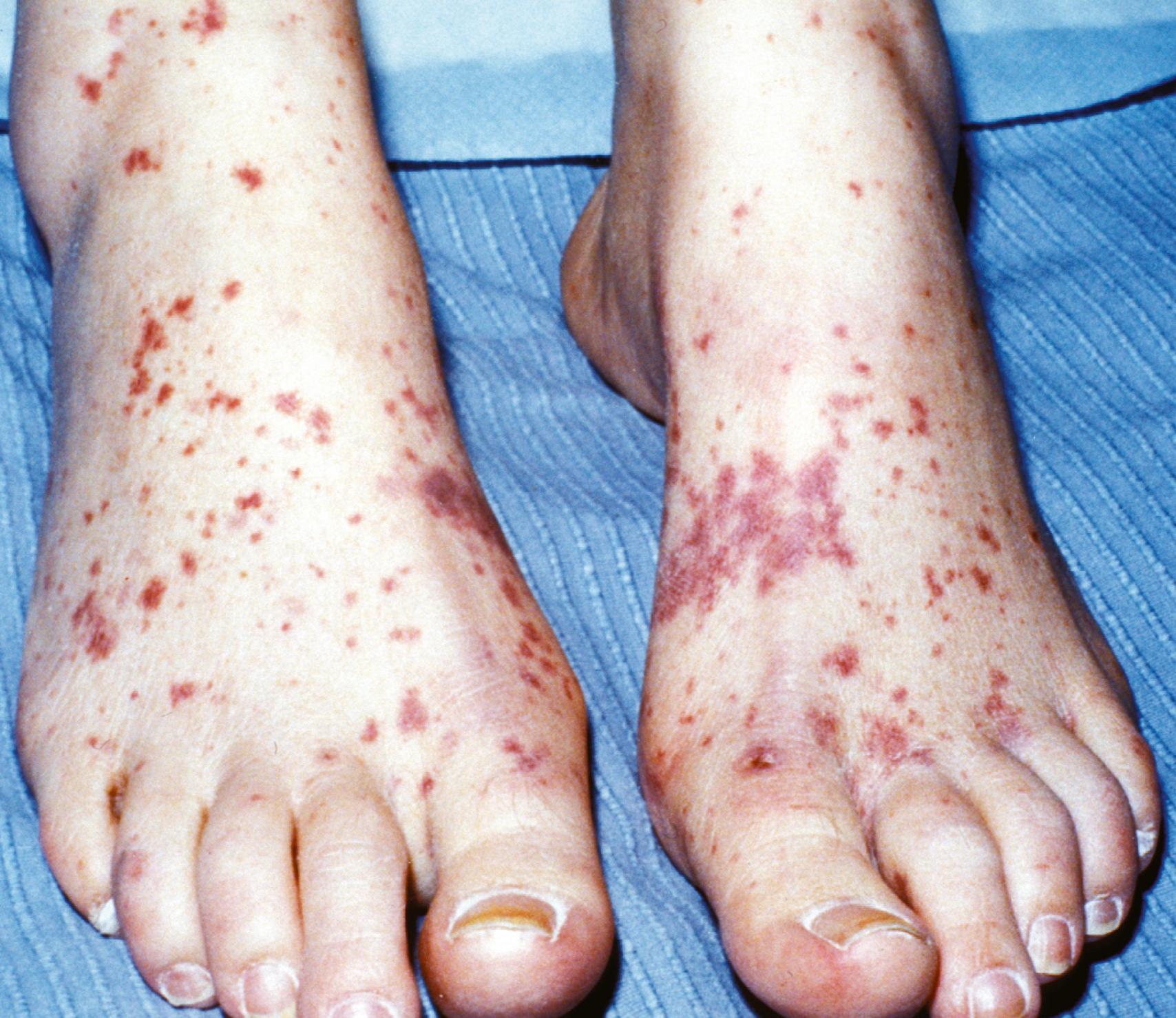 Fig. 23.15, Vasculitic purpura in a teenage girl with an acute exacerbation of systemic lupus erythematosus.