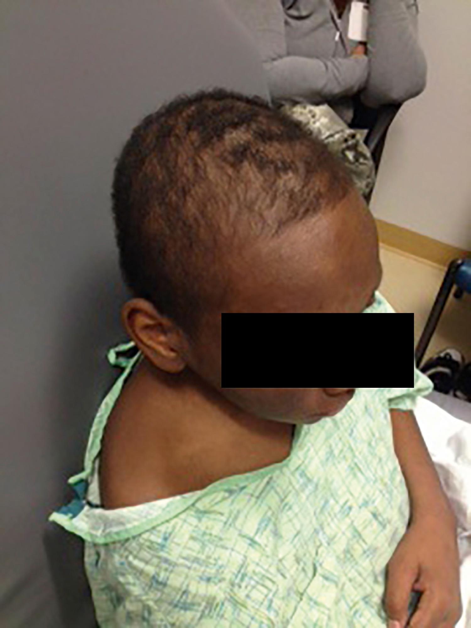 Fig. 23.16, Diffuse alopecia at presentation of systemic lupus erythematosus.